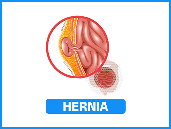 Hernia