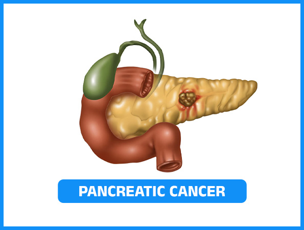 Pancreatic Cancer